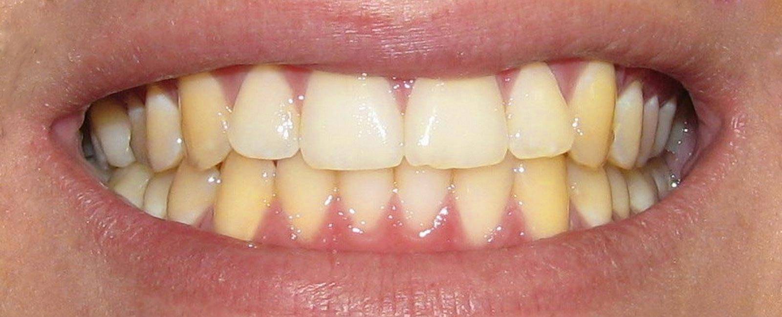 Как удалить пятна от чая с зубов - советы стоматологов.