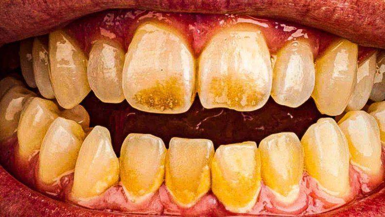 Болит зуб после прочистки канала – это нормально?