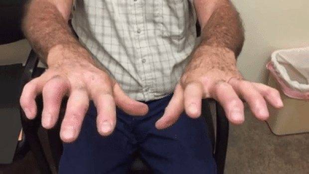 Эссенциальный тремор: лечение, причины и симптомы тремора рук