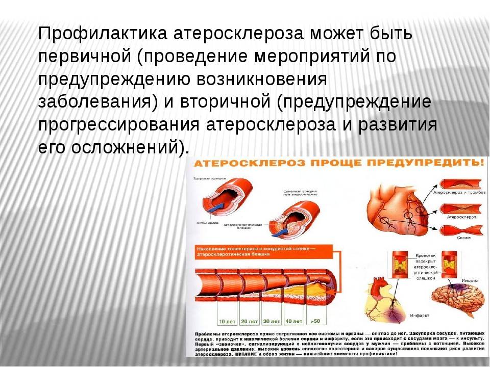 Подсказки фармацевту: лс при атеросклерозе