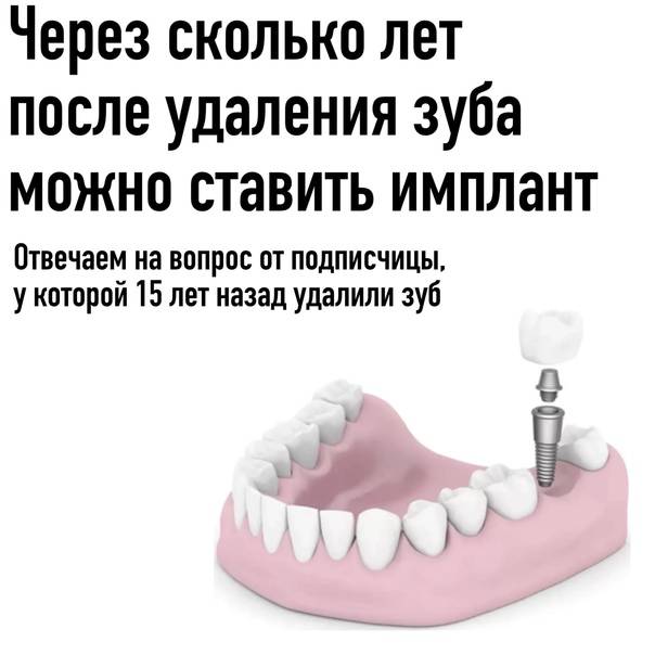 Удаление зуба |