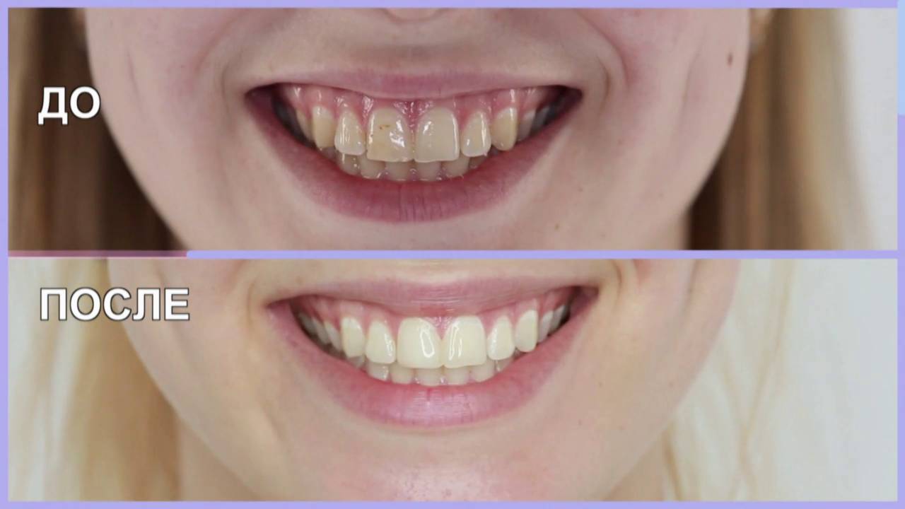 Методы устранения пятен от кофе на зубах - «стоматология на марата 31»