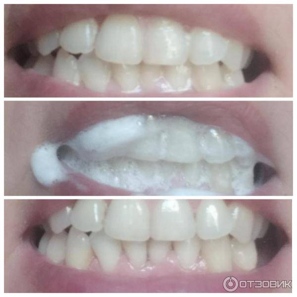 Желтые зубы: причины, что делать – стоматология президент